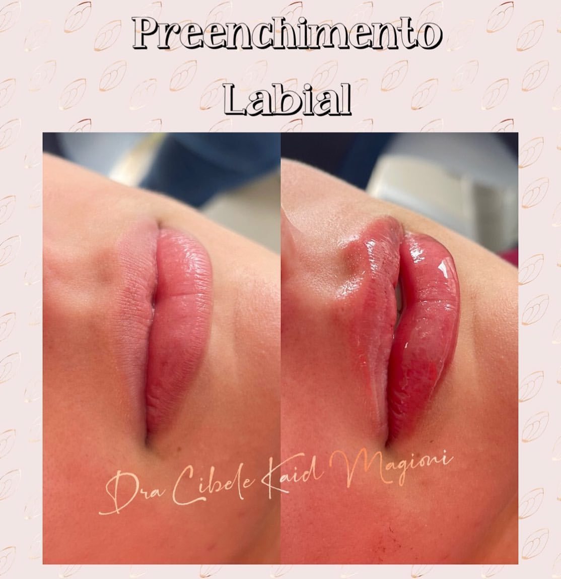 Escultura e Preenchimento Labial (antes e depois)